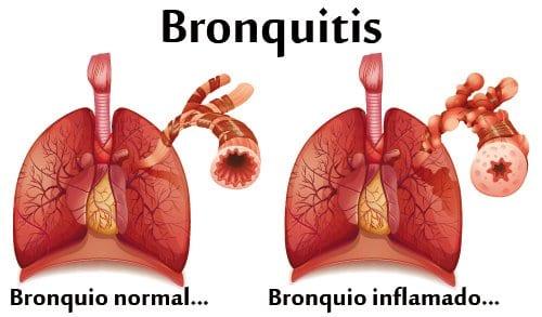 Remedios caseros para la bronquitis Alivio Rapido