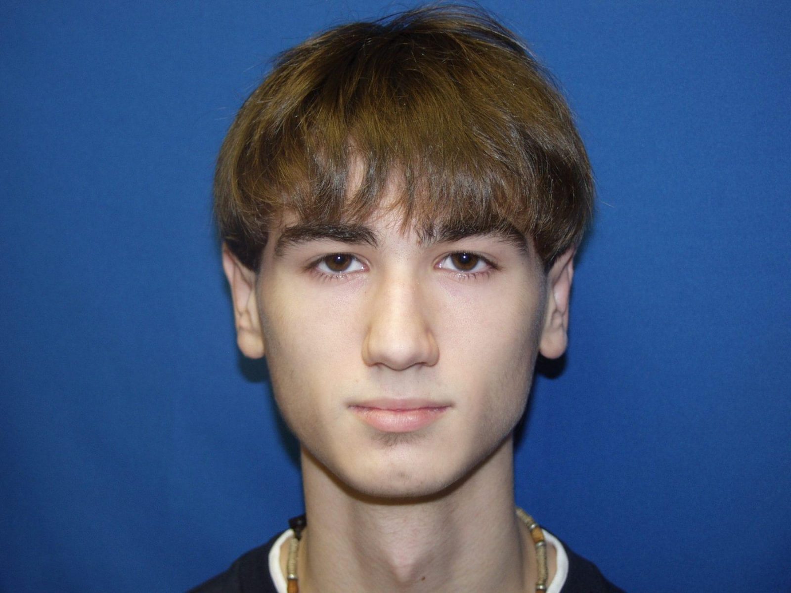 Microtia antes y despues de adelgazar