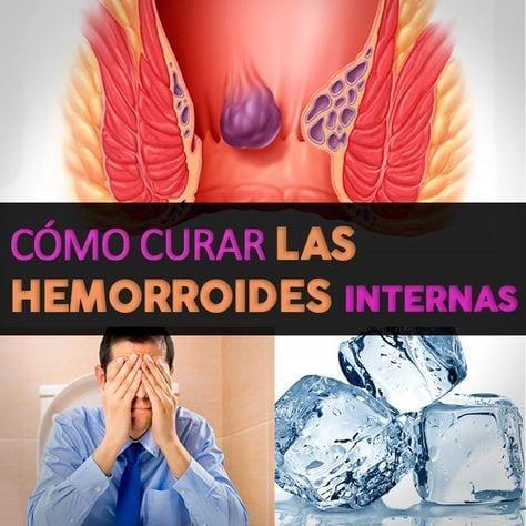 remedios para quitar las hemorroides internas