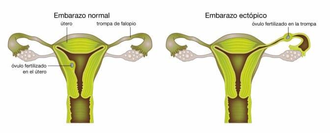 ¿Qué causa un embarazo ectópico?